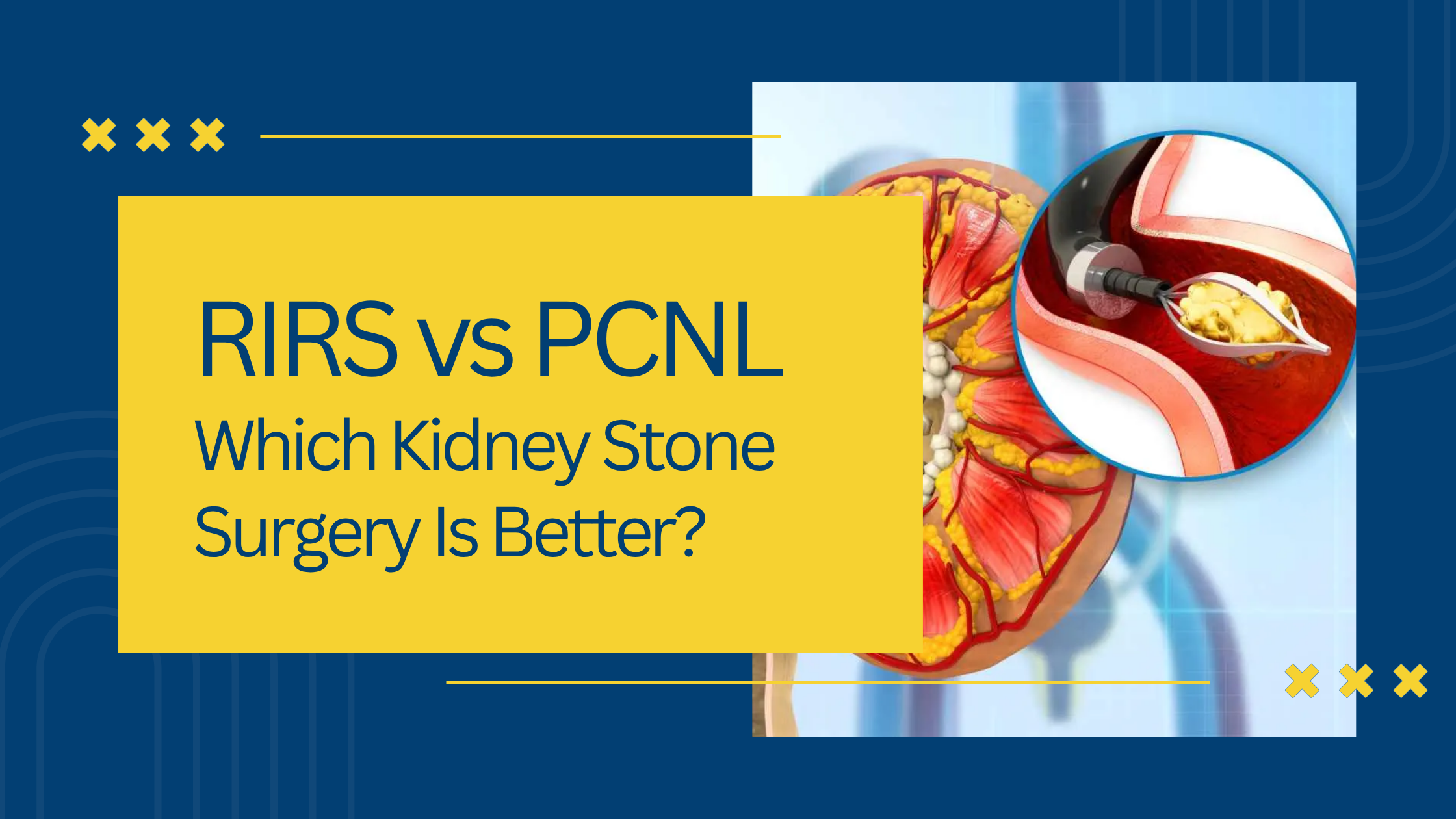 RIRS vs PCNL: Which Kidney Stone Surgery Is Better?